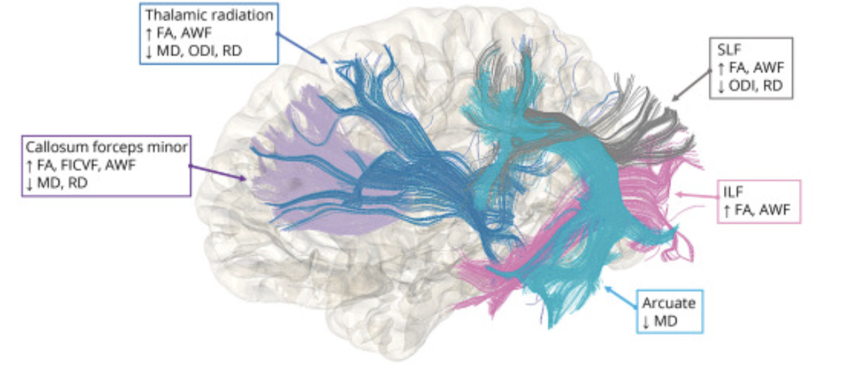 Microstructural Alterations in Tract Development in College Football and Volleyball Players